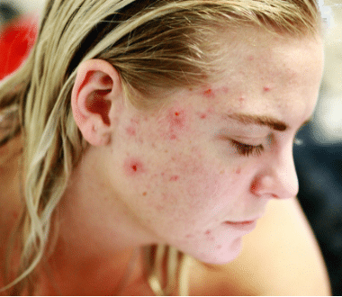 Acnes